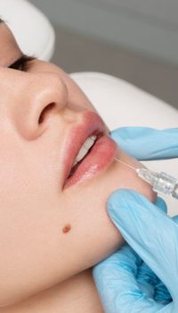 Russian-Lip-Filler-Trend