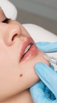 Russian-Lip-Filler-Trend